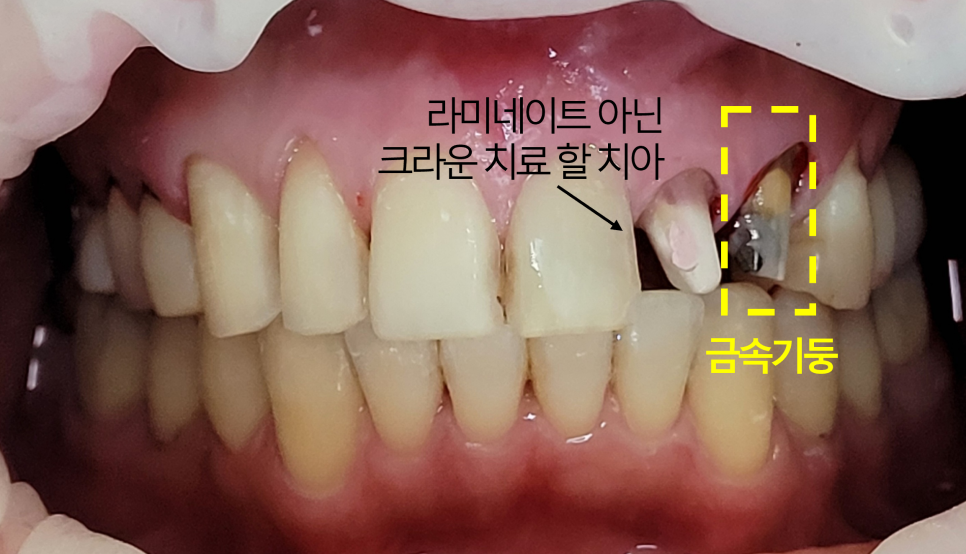 Improving Yellowed Front Teeth with Laminates: When Gum Treatment Is Needed Before Laminates image 6