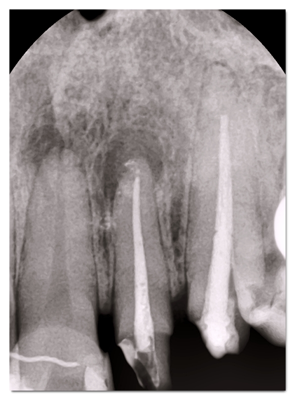 When Your Front Tooth Is Cracked, Do You Need to Visit the Dentist Immediately? (What to Check Before It Breaks) image 9