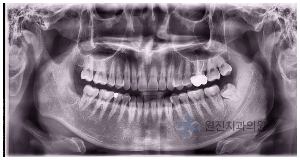 비발치교정, 나도 치아를 안 뽑고 할 수 있을까? 관련 이미지 8