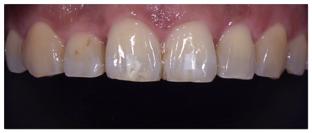 How to Whiten Yellow Teeth? Teeth Whitening vs. Veneers image 2