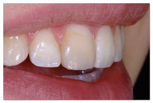 A Complete Guide to the Causes of Front Tooth Resin Discoloration and Solutions by Type image 3
