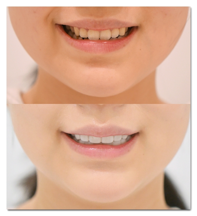 Which Is Better for Crowded Teeth: Veneers or Orthodontic Treatment? image 8