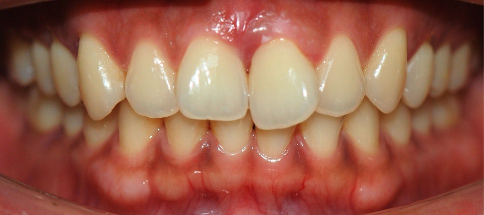 강남원진치과, 앞니부분교정 &lsquo;이 기준&rsquo; 확인하세요 관련 이미지 4