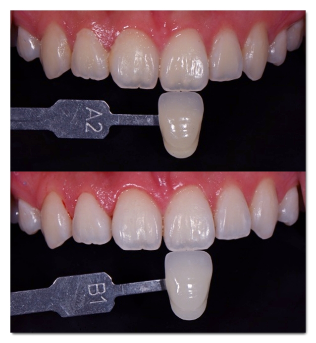Teeth Whitening Costs, DIY Comparison, Procedure, Duration, and Care: A Complete Guide image 4