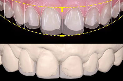 원진치과, 변색된 앞니 브리네이트로 티 안 나게 하는 2가지 기준 (의사조언) 관련 이미지 2