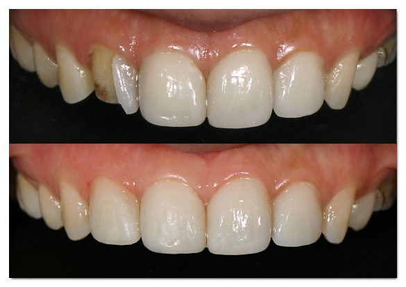 How Many Veneers Should You Get? Criteria for Making Your Choice image 6