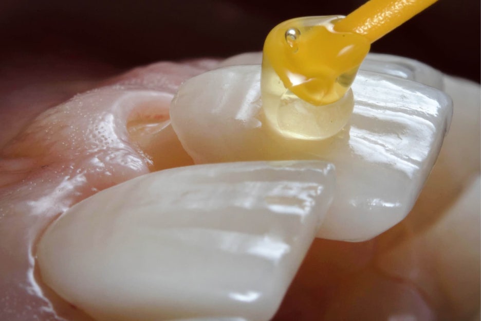 원진치과, 변색된 앞니 브리네이트로 티 안 나게 하는 2가지 기준 (의사조언) 관련 이미지 10