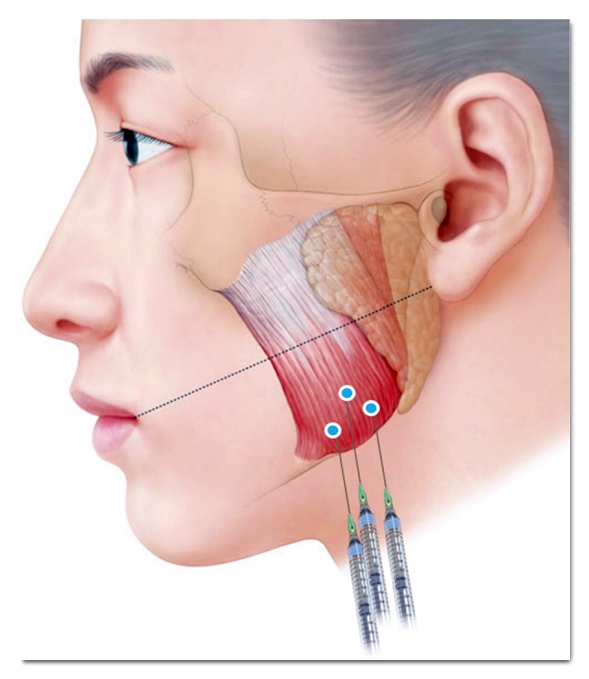 Why You Should Get TMJ Botox at a Dental Clinic image 3