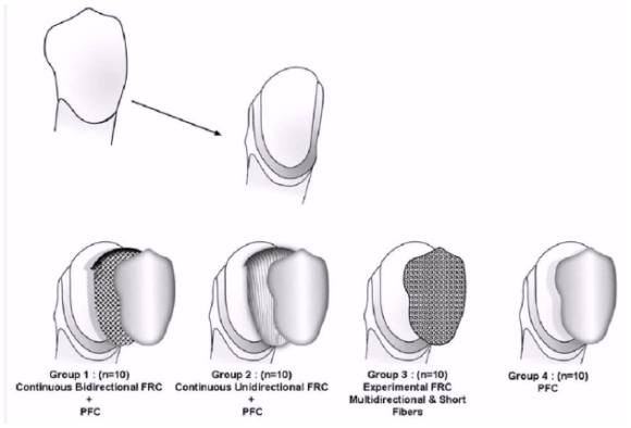 원진치과, 변색된 앞니 브리네이트로 티 안 나게 하는 2가지 기준 (의사조언) 관련 이미지 4