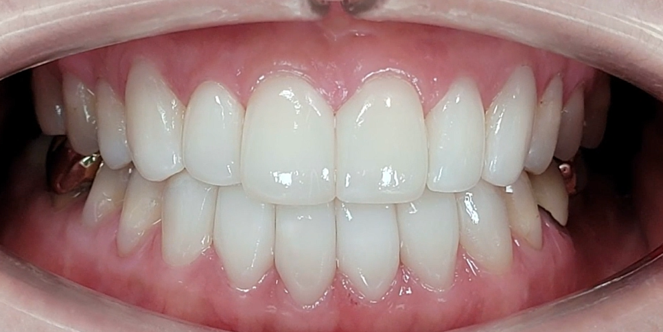 서초동치과, 앞니 사이가 까많게 보여요 <블랙트라이앵글 치료사례> 관련 이미지 13