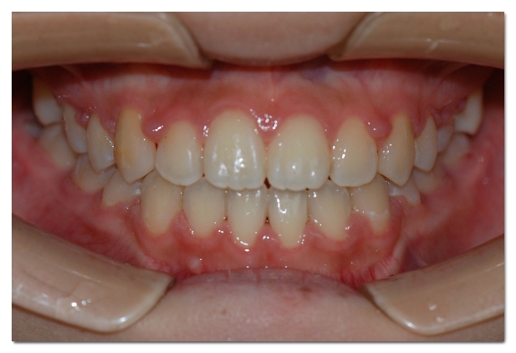 Can Malocclusion Be Treated with Veneers Without Orthodontics? image 6