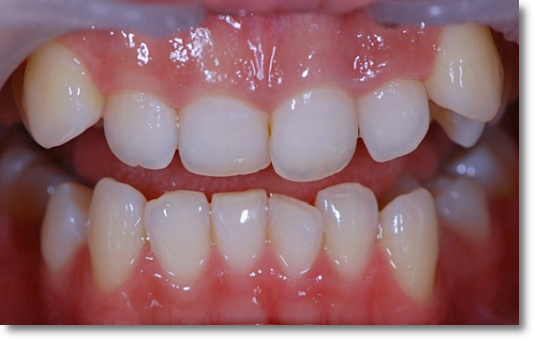 When Is Partial Orthodontic Treatment for the Front Teeth Possible? image 3
