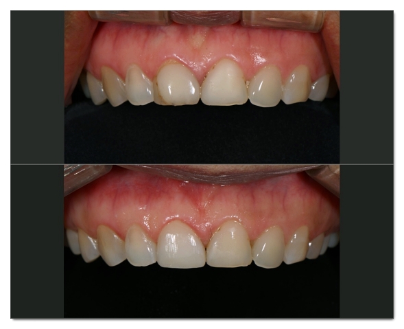 How Many Veneers Should You Get? Criteria for Making Your Choice image 4