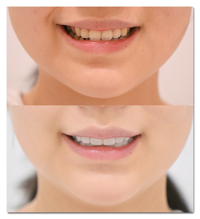 Dental Veneers for Front Teeth: When Are They a Good Option? image 4