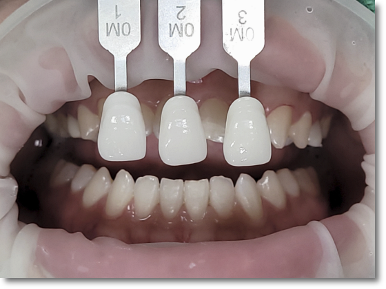 Can No-Prep Veneers Be Used on Every Tooth? image 6