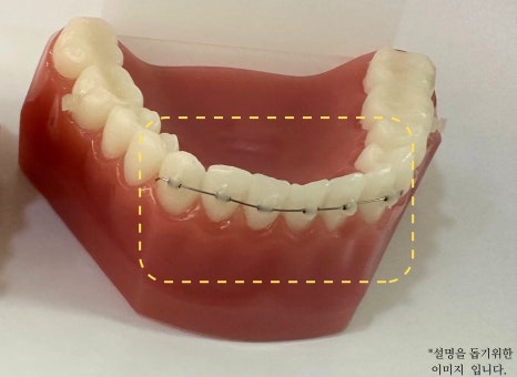 역삼동 앞니벌어짐, 브리네이트 vs 라미네이트 (의사조언) 관련 이미지 4