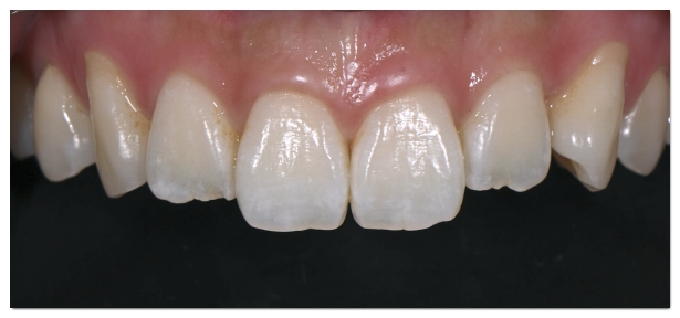 Which Is Better for Crowded Teeth: Veneers or Orthodontic Treatment? image 10