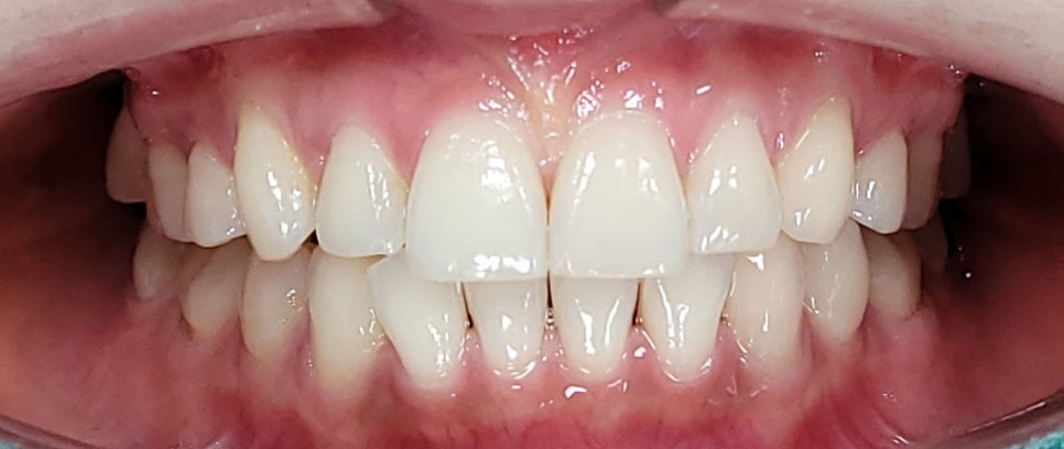 양재역 라미네이트, 과하지 않게 앞니 개선 가능한가요? 관련 이미지 12