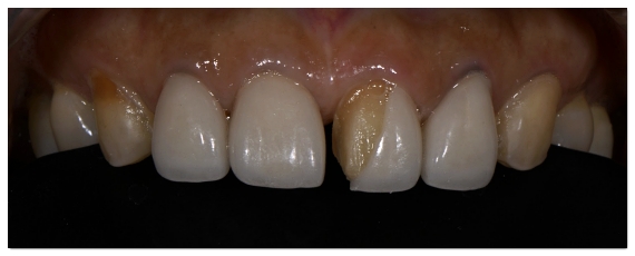 Why the Amount of Tooth Reduction for Veneers Determines Your Oral Health for Life image 2