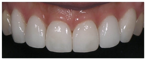 Which Is Better for Crowded Teeth: Veneers or Orthodontic Treatment? image 11