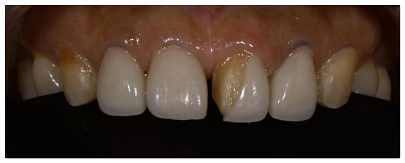 When Your Front Tooth Is Cracked, Do You Need to Visit the Dentist Immediately? (What to Check Before It Breaks) image 2