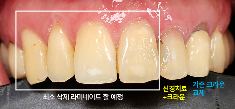Improving Yellowed Front Teeth with Laminates: When Gum Treatment Is Needed Before Laminates image 5