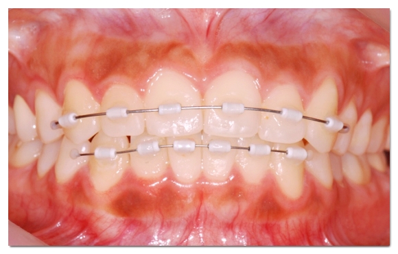 Why the Amount of Tooth Reduction for Veneers Determines Your Oral Health for Life image 8