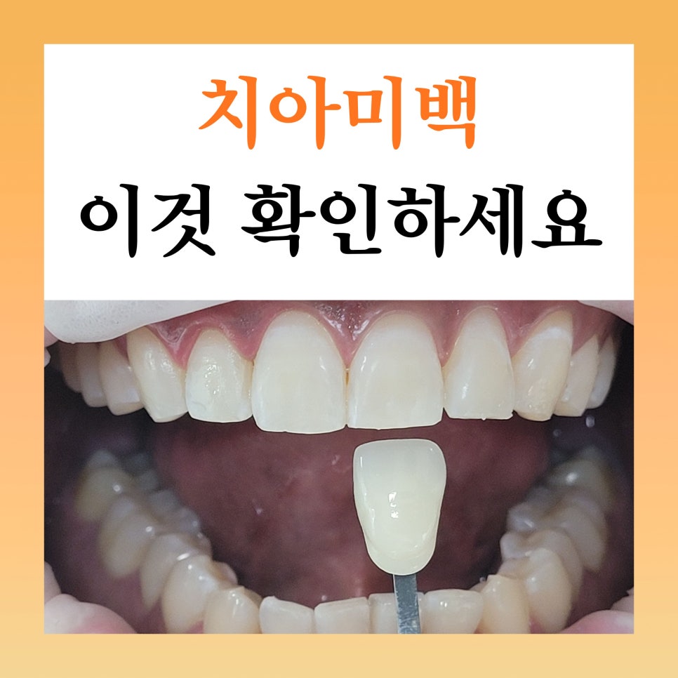 역삼동치아미백, 시작 전 이 2가지는 꼭 확인하세요 (의사작성) 관련 이미지 2