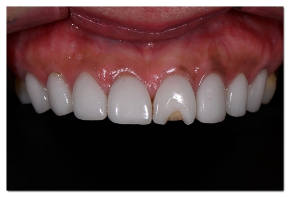 Why the Amount of Tooth Reduction for Veneers Determines Your Oral Health for Life image 12