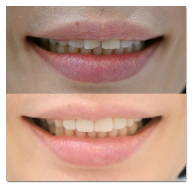 Which Is Better for Crowded Teeth: Veneers or Orthodontic Treatment? image 13