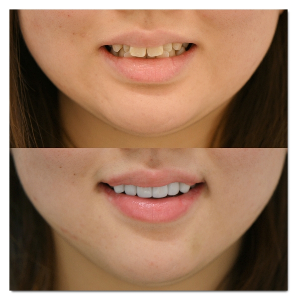 How Many Veneers Should You Get? Criteria for Making Your Choice image 8
