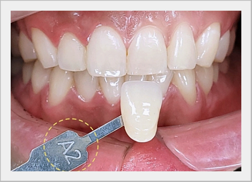 What to Look for When Choosing a Laminate Veneer Clinic image 2