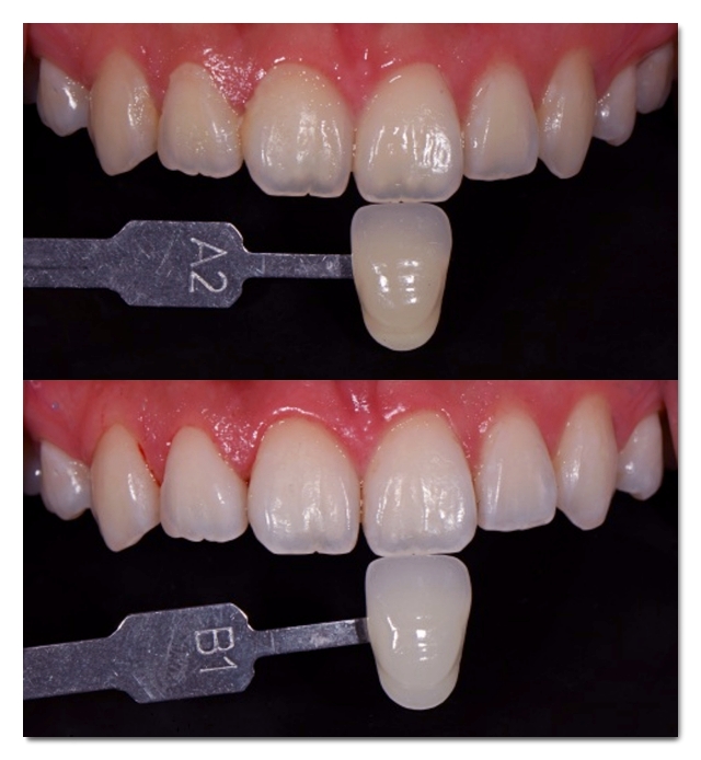 One-Day Teeth Whitening? How to Brighten Your Front Teeth in Just One Day image 3