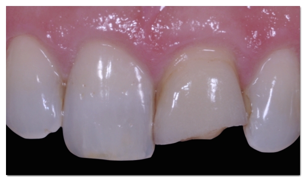 What to Do When a Laminate Veneer Breaks and the Treatment Approach image 1