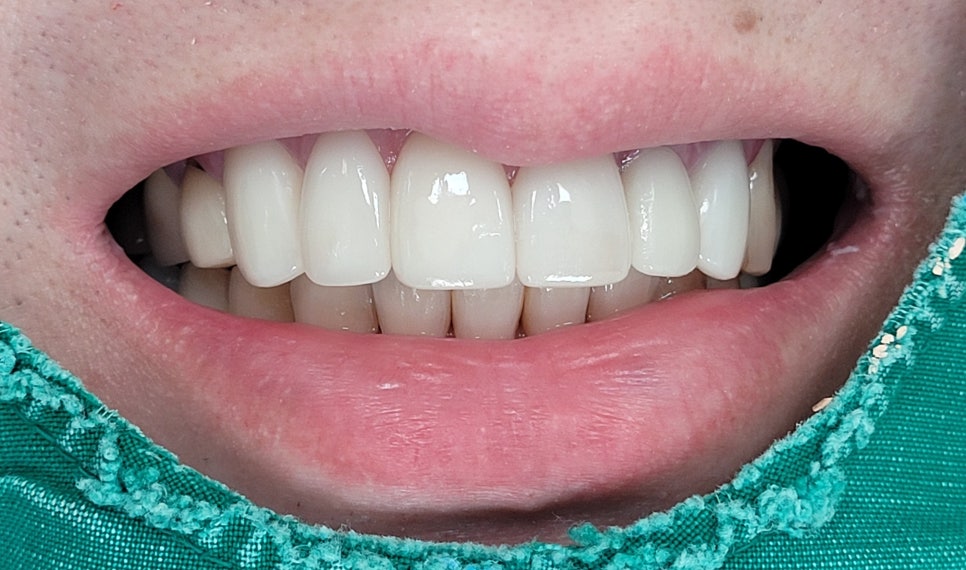 Improving Yellowed Front Teeth with Laminates: When Gum Treatment Is Needed Before Laminates image 8