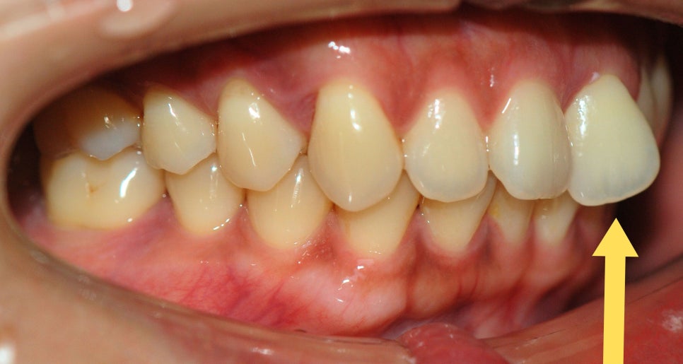 강남원진치과, 앞니부분교정 &lsquo;이 기준&rsquo; 확인하세요 관련 이미지 6