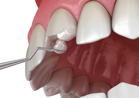 역삼동 앞니벌어짐, 브리네이트 vs 라미네이트 (의사조언) 관련 이미지 11