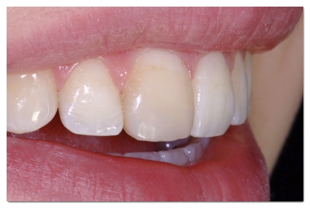 Why Teeth Turn Yellow and 4 Proper Ways to Address It image 2
