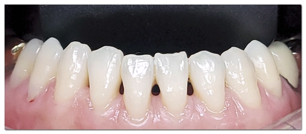 Black Triangles After Orthodontic Treatment: The Solution Depends on the Cause image 2