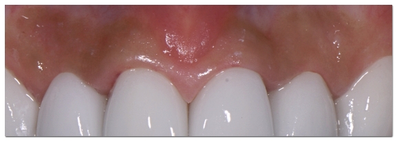 Swollen Gums: A Complete Guide to the Causes and Signs You Should Visit the Dentist image 2