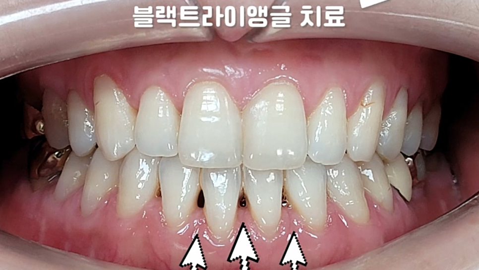 서초동치과, 앞니 사이가 까많게 보여요 <블랙트라이앵글 치료사례> 관련 이미지 12