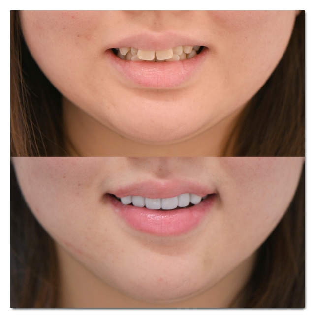 Dental Veneers for Front Teeth: When Are They a Good Option? image 9