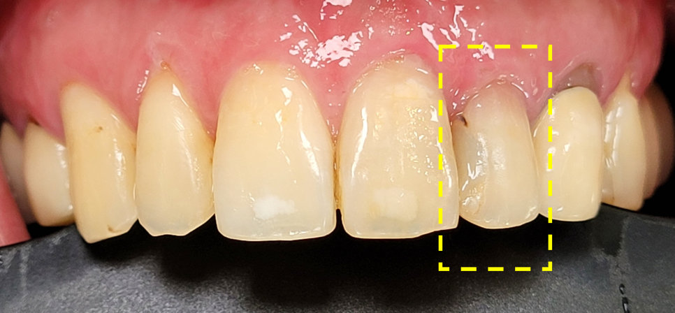 Improving Yellowed Front Teeth with Laminates: When Gum Treatment Is Needed Before Laminates image 3