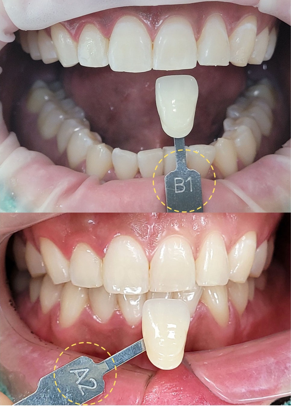 역삼동치아미백, 시작 전 이 2가지는 꼭 확인하세요 (의사작성) 관련 이미지 12