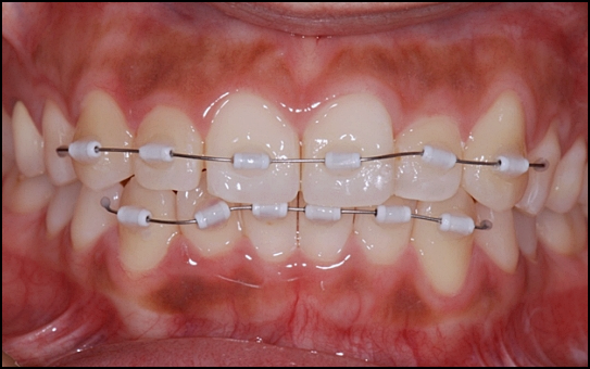 Laminates or Orthodontics: How to Choose for Gapped Front Teeth? image 6