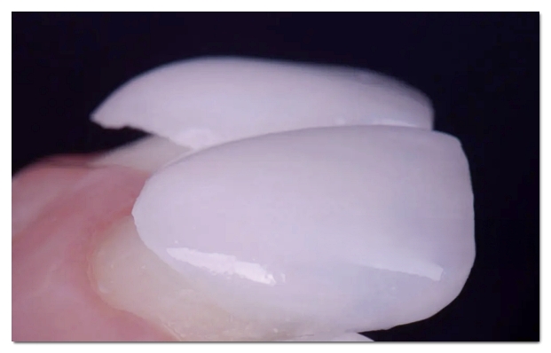 How to Whiten Yellow Teeth? Teeth Whitening vs. Veneers image 10