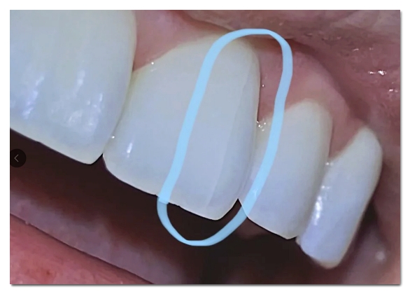 When Your Front Tooth Is Cracked, Do You Need to Visit the Dentist Immediately? (What to Check Before It Breaks) image 5