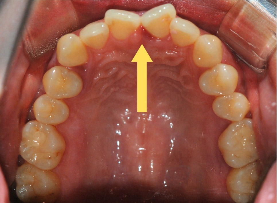 강남원진치과, 앞니부분교정 &lsquo;이 기준&rsquo; 확인하세요 관련 이미지 5
