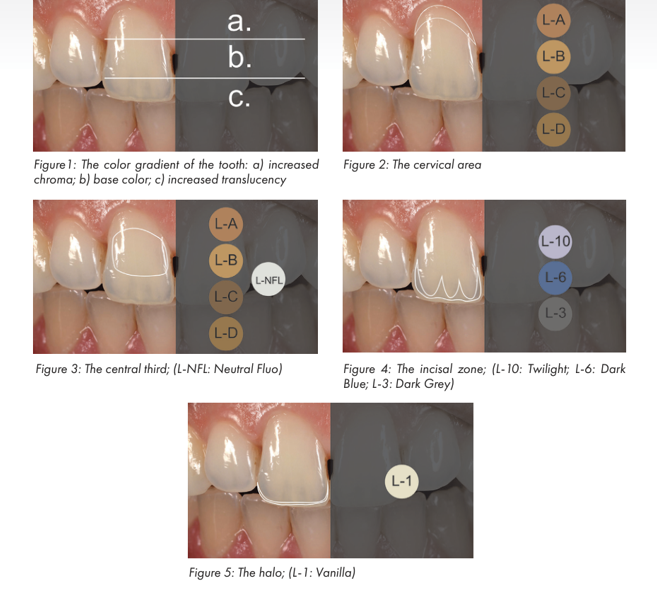역삼동 앞니 임플란트 교체 신호 3가지 (의사작성) 관련 이미지 7