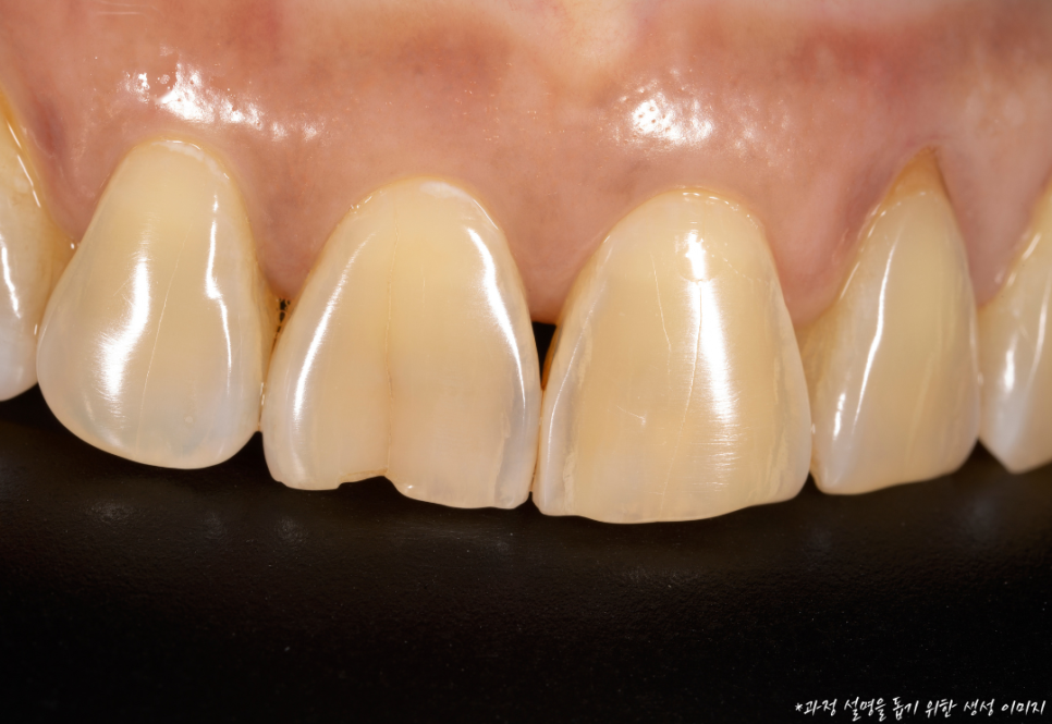 역삼동 앞니벌어짐, 브리네이트 vs 라미네이트 (의사조언) 관련 이미지 12